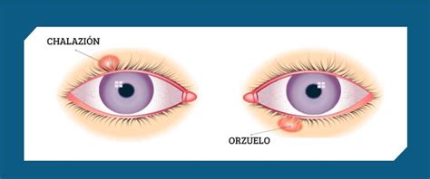 Causas De Orzuelo Tipos Y Factores De Riesgo Meditip Causas De Orzuelo Tipos Y Factores De Riesgo Meditip